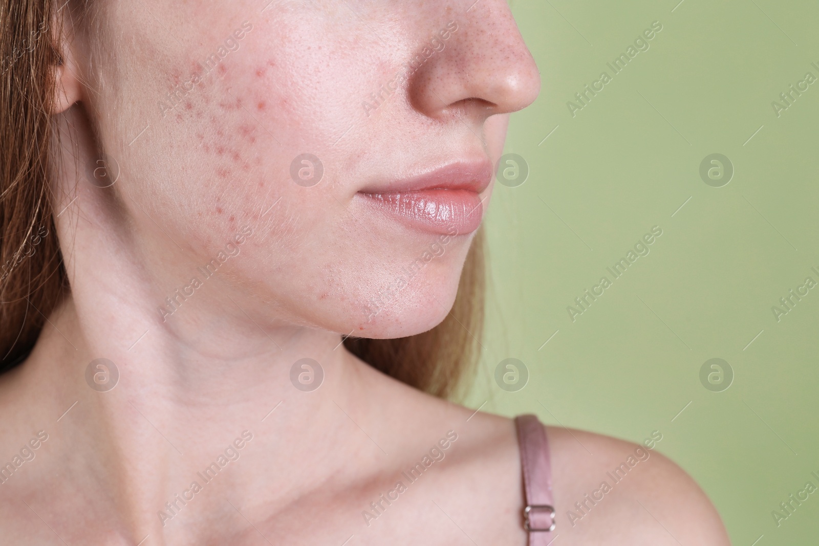 Photo of Young woman with acne problem on olive background, closeup