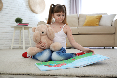 Photo of Little girl with chickenpox reading book at home