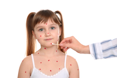 Woman applying cream onto skin of little girl with chickenpox on white background