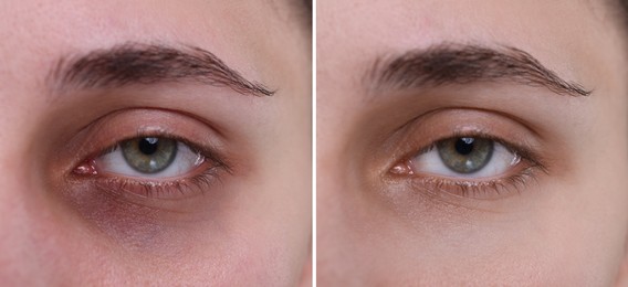 Collage with photos of woman with dark circle under eye before and after treatment, closeup