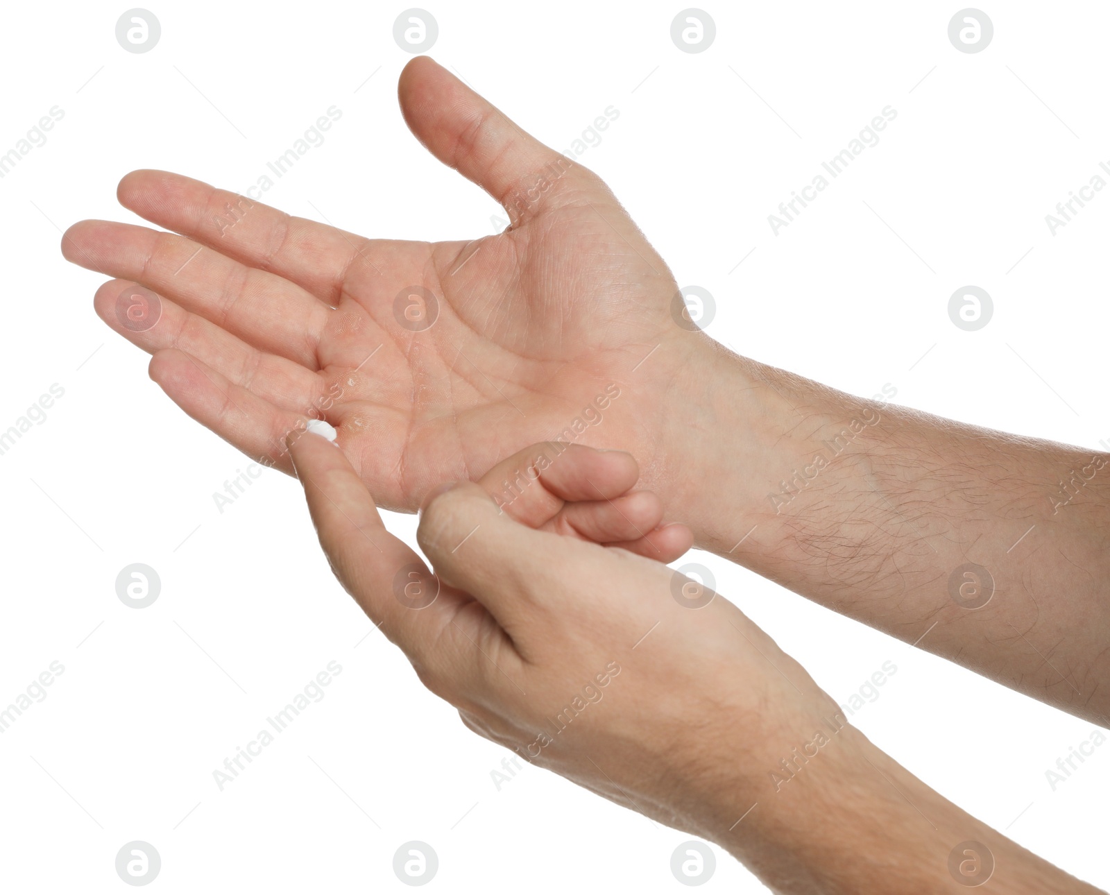 Photo of Man applying cream on hand for calluses treatment against white background, closeup