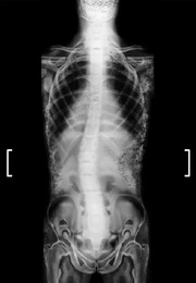 Illustration of X-ray of human spine showing curvature. Patient suffering from scoliosis