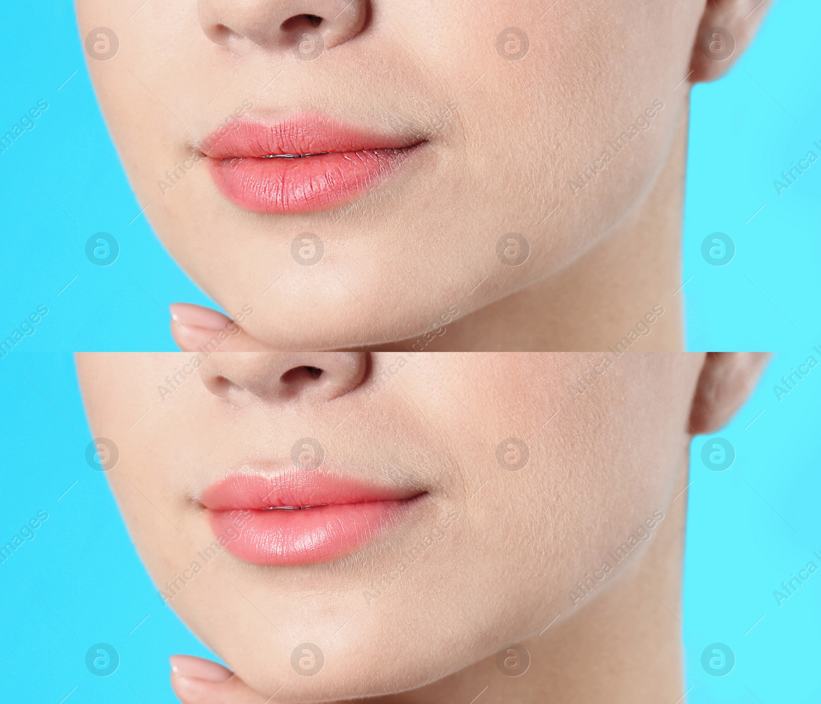 Image of Collage with photos of woman before and after using lip balm on light blue background, closeup