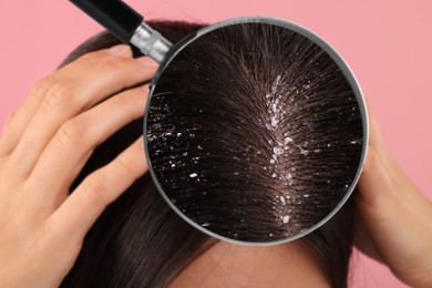 Woman suffering from dandruff on pink background, closeup. View through magnifying glass on hair with flakes