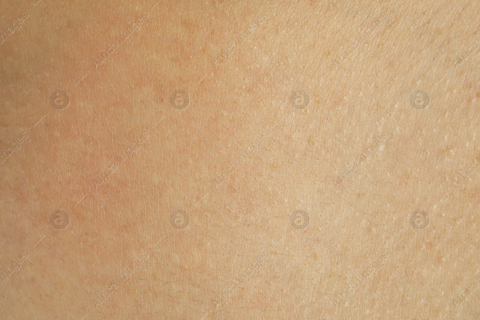 Photo of Texture of human skin with birthmarks, closeup view