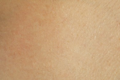 Photo of Texture of human skin with birthmarks, closeup view