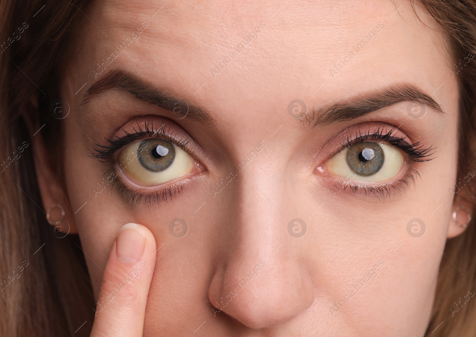 Photo of Woman checking her health condition on white background, closeup. Yellow eyes as symptom of problems with liver