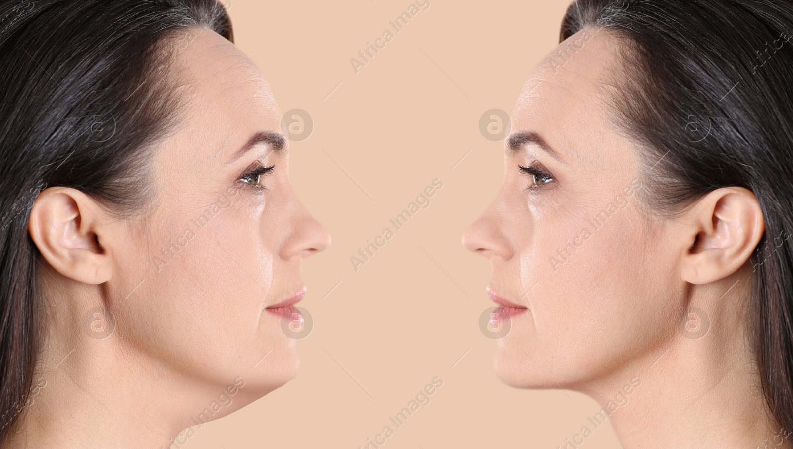 Image of Double chin problem. Collage with photos of mature woman before and after plastic surgery procedure on beige background