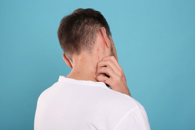 Man with rash suffering from monkeypox virus on light blue background, back view