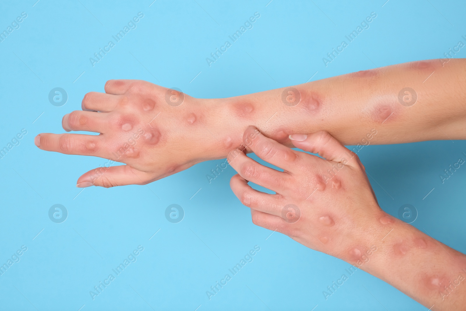 Photo of Woman with rash suffering from monkeypox virus on light blue background, closeup