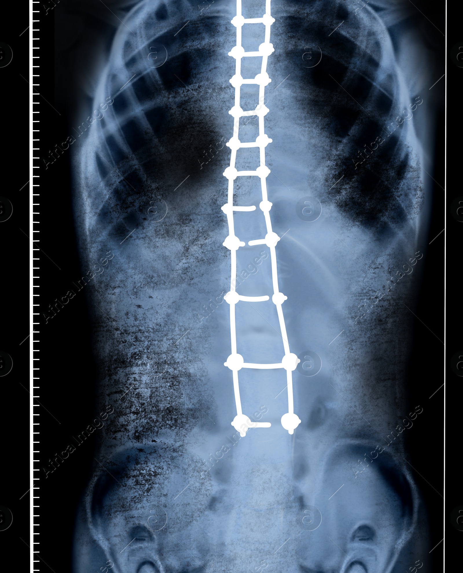 Illustration of X-ray of human spine showing curvature. Patient suffering from scoliosis