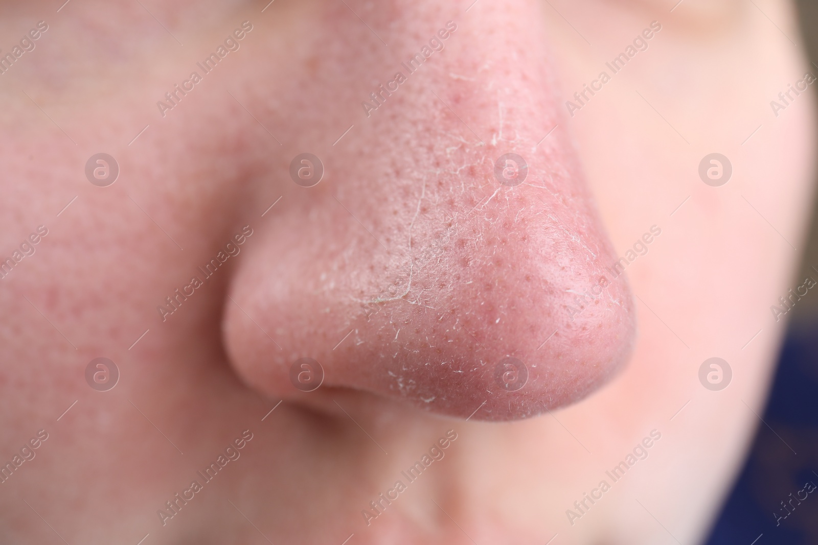 Photo of Woman with dry skin on nose, closeup