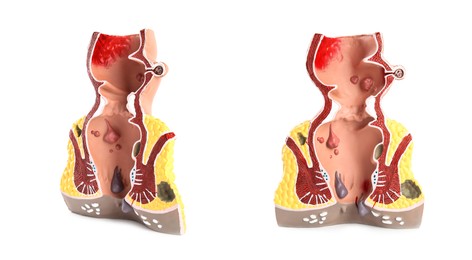 Image of Anatomical model of rectum with hemorrhoids on white background, collage