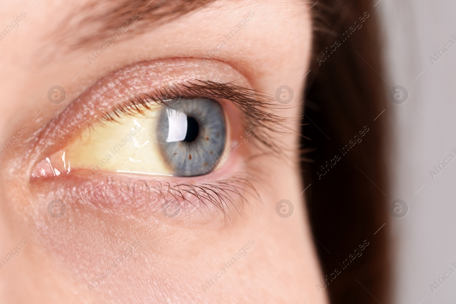 Photo of Woman with yellow eyes, closeup view. Symptom of hepatitis