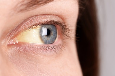 Photo of Woman with yellow eyes, closeup view. Symptom of hepatitis