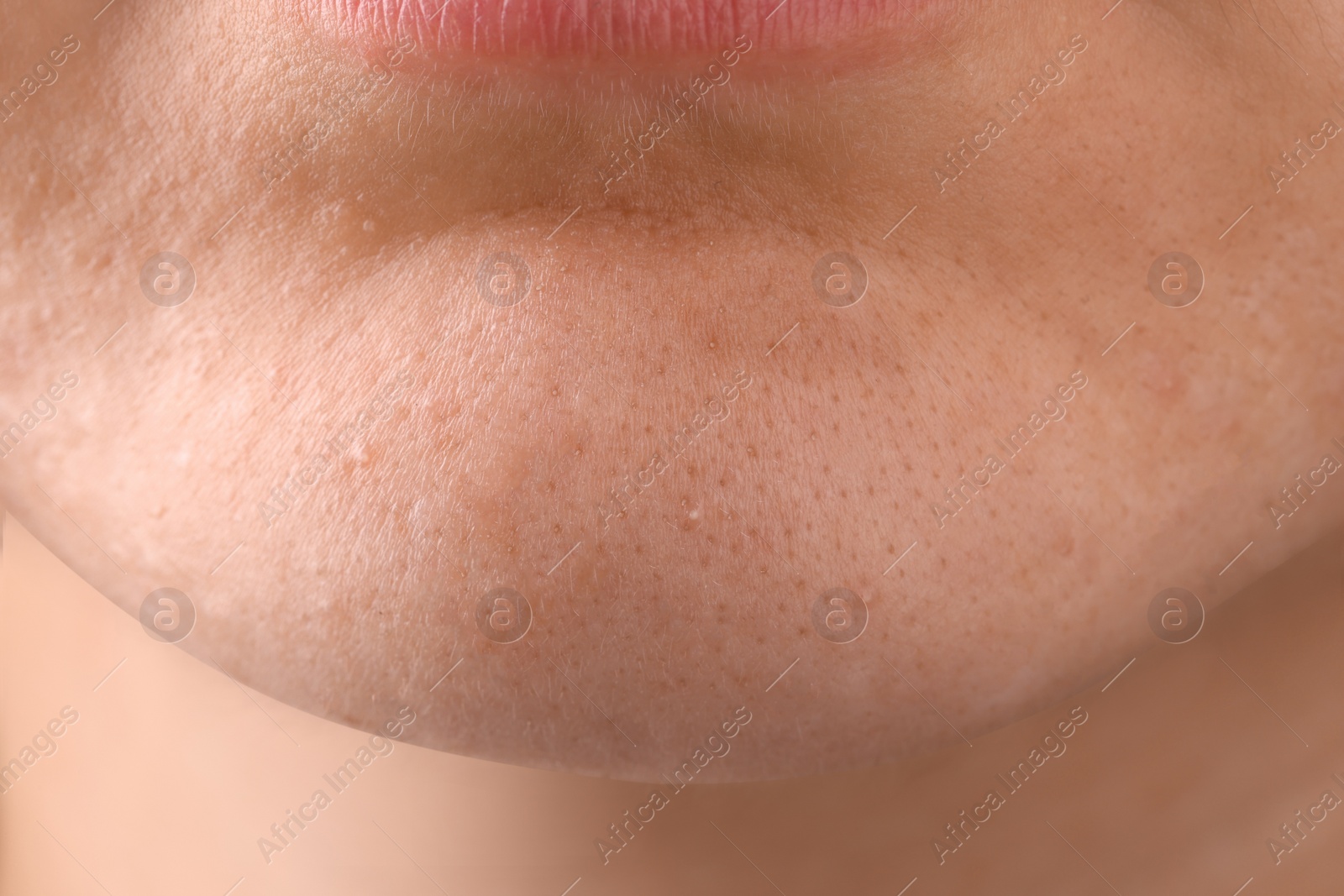 Photo of Young woman with acne problem, closeup view