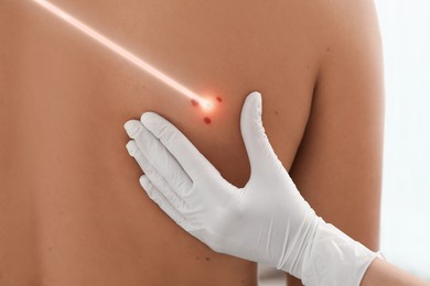 Laser mole removal. Doctor checking patient's skin during procedure on white background, closeup