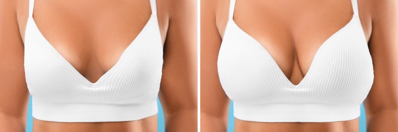 Woman before and after breast augmentation, closeup. Collage with photos showing difference between breast sizes