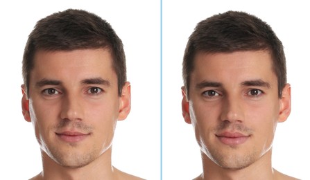 Collage with photos of man before and after lips augmentation