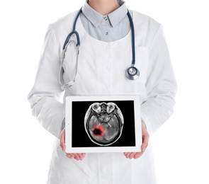 Doctor showing x-ray of patient with brain cancer on tablet against white background, closeup