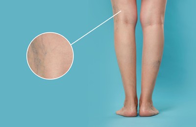 Image of Woman suffering from varicose veins on light blue background, closeup. Magnified skin surface showing affected area