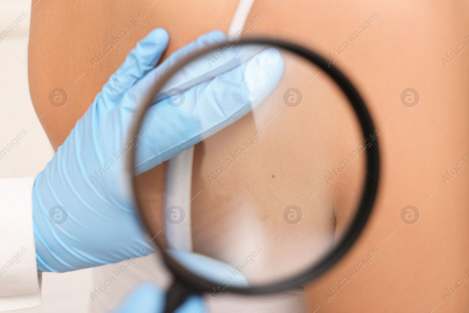 Photo of Dermatologist examining patient's birthmark with magnifying glass, closeup