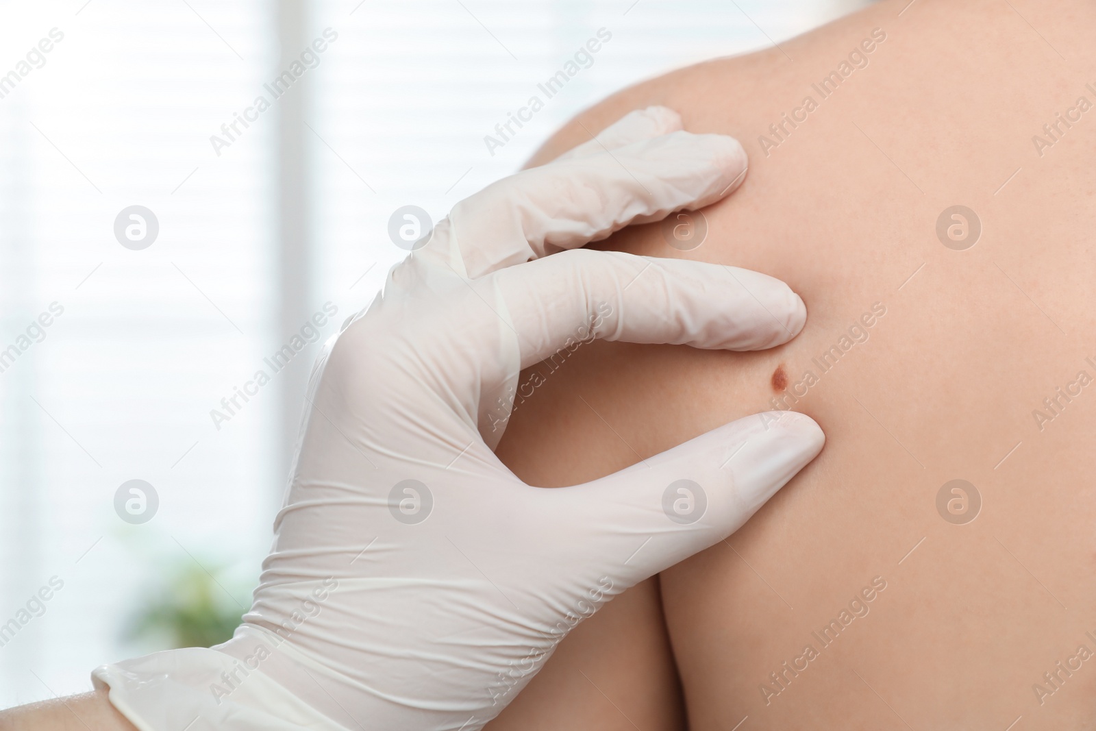 Photo of Dermatologist examining patient's birthmark in clinic, closeup view