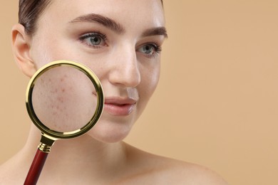 Image of Dermatology. Woman with skin problem on beige background, closeup. View through magnifying glass on acne