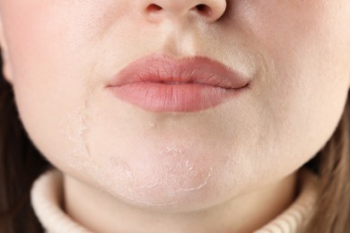 Closeup view of woman with dry skin