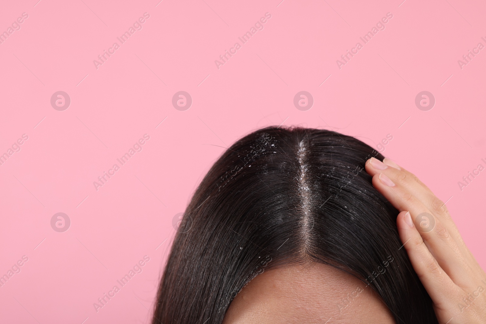 Photo of Woman with dandruff in her dark hair on pink background, closeup. Space for text