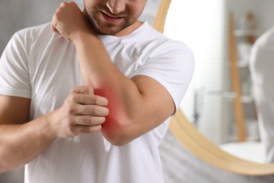 Photo of Man suffering from allergy scratching his arm indoors, closeup