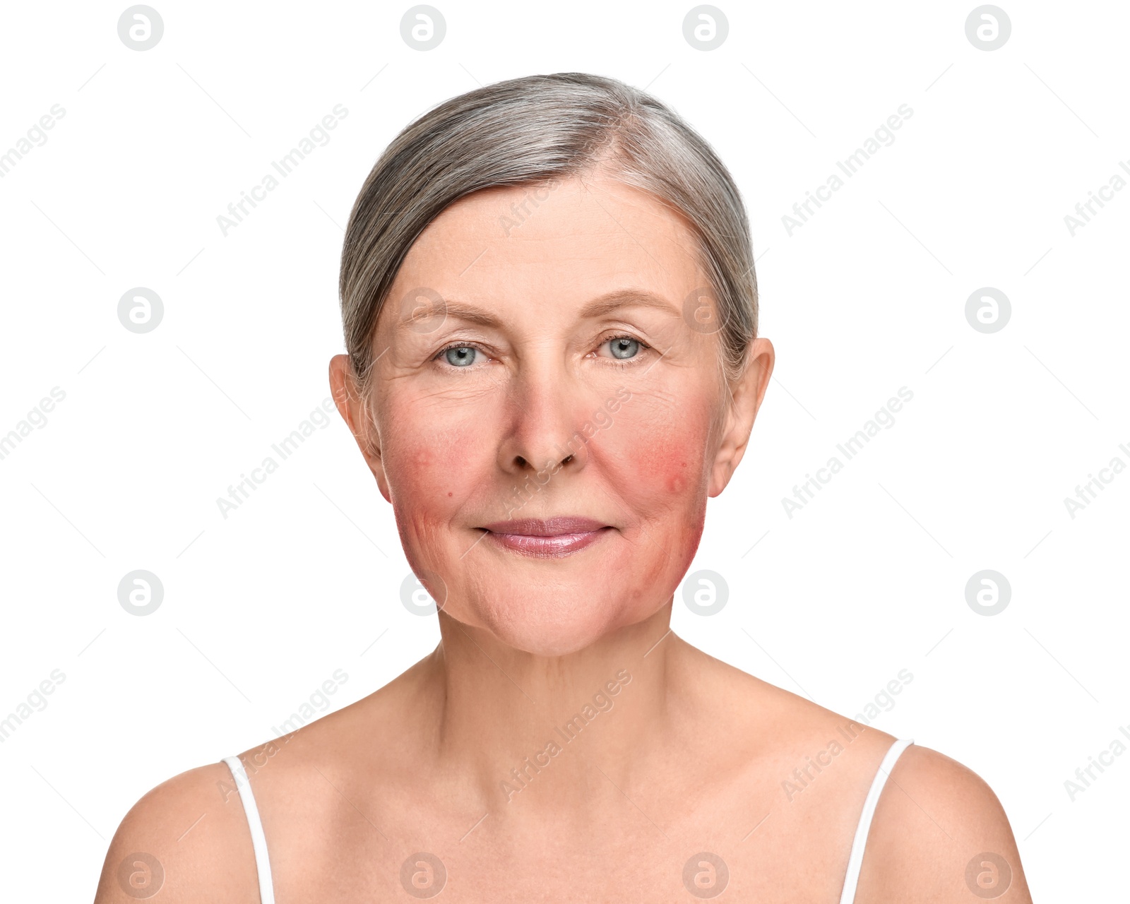 Image of Woman with rosacea on white background. Problem skin treatment
