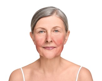 Woman with rosacea on white background. Problem skin treatment