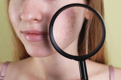 Photo of Young woman with acne problem holding magnifying glass near her skin on olive background, closeup
