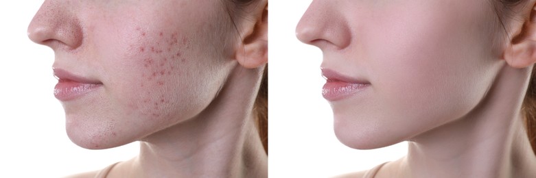 Acne problem. Young woman before and after treatment on white background, closeup. Collage of photos