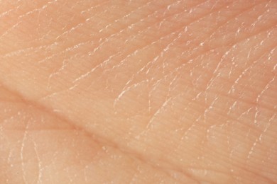 Photo of Texture of dry skin as background, macro view