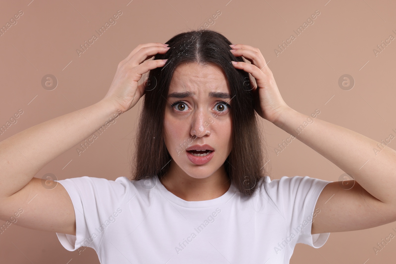 Photo of Emotional woman suffering from dandruff problem on beige background