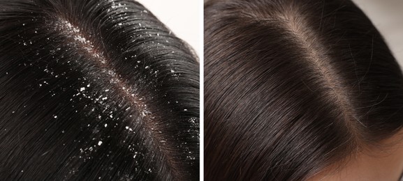 Image of Woman showing hair before and after dandruff treatment, collage