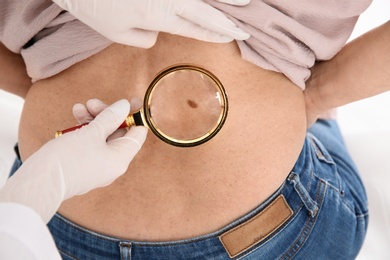 Dermatologist examining mature patient's birthmark with magnifying glass in clinic, closeup