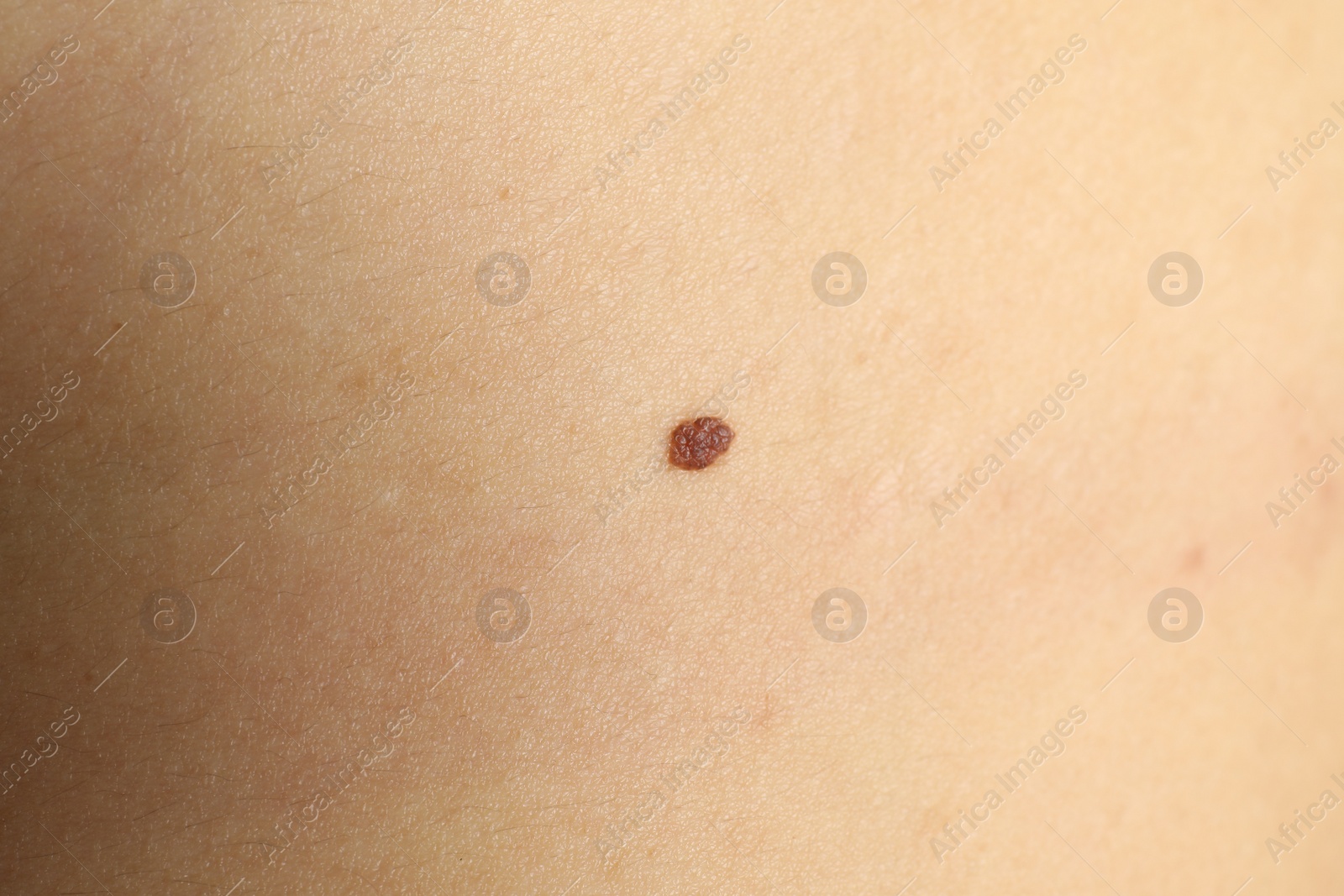 Photo of Closeup view of woman's body with birthmark as background