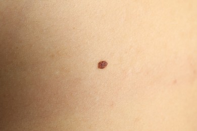 Closeup view of woman's body with birthmark as background