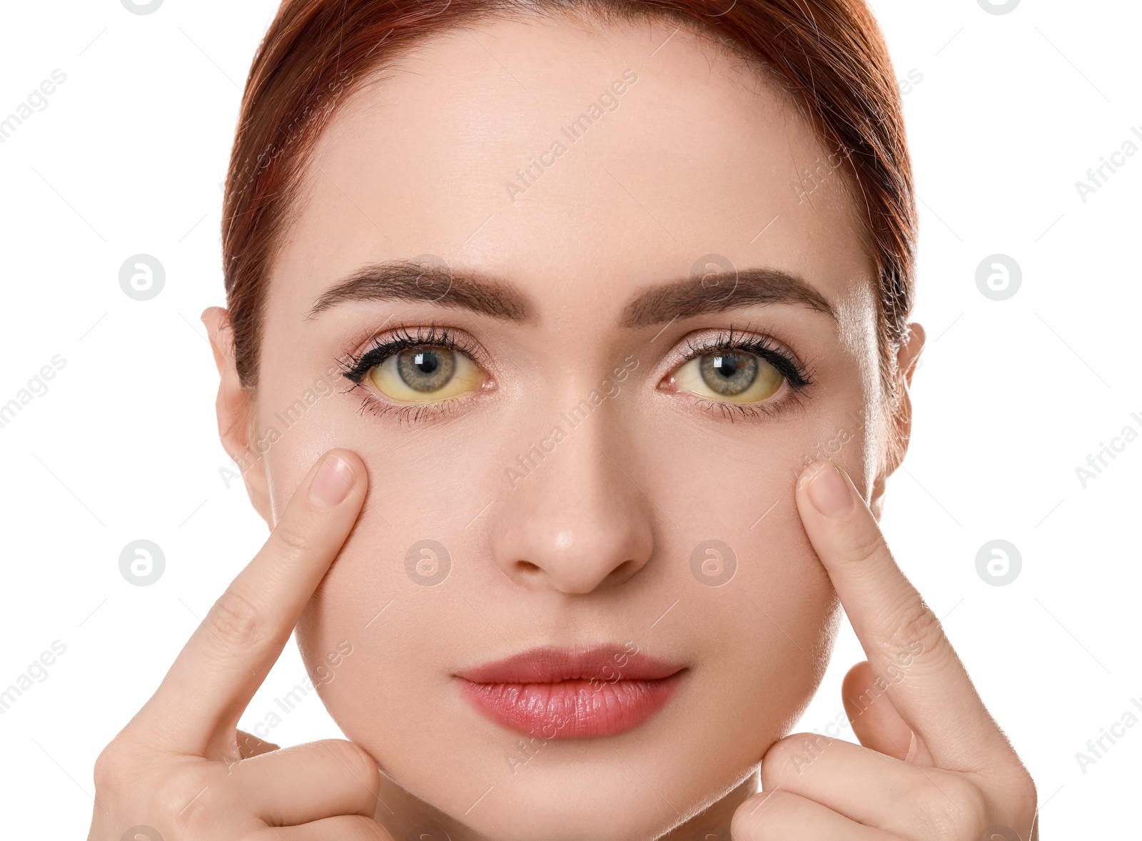 Photo of Woman with yellow eyes on white background. Symptom of hepatitis