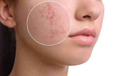 Image of Teenage girl with acne problem on white background, closeup