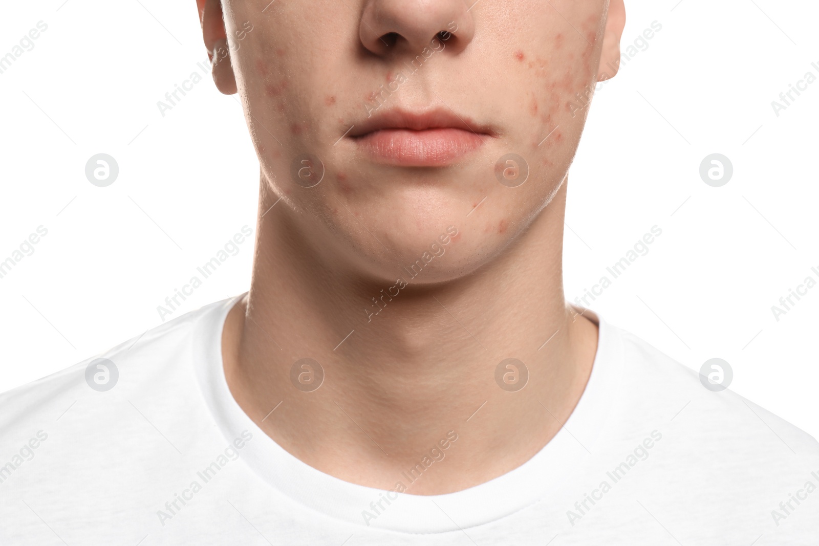 Photo of Teen guy with acne problem on white background, closeup