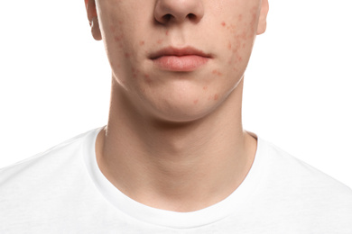 Teen guy with acne problem on white background, closeup