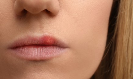 Photo of Woman suffering from herpes, closeup. Dermatological problem