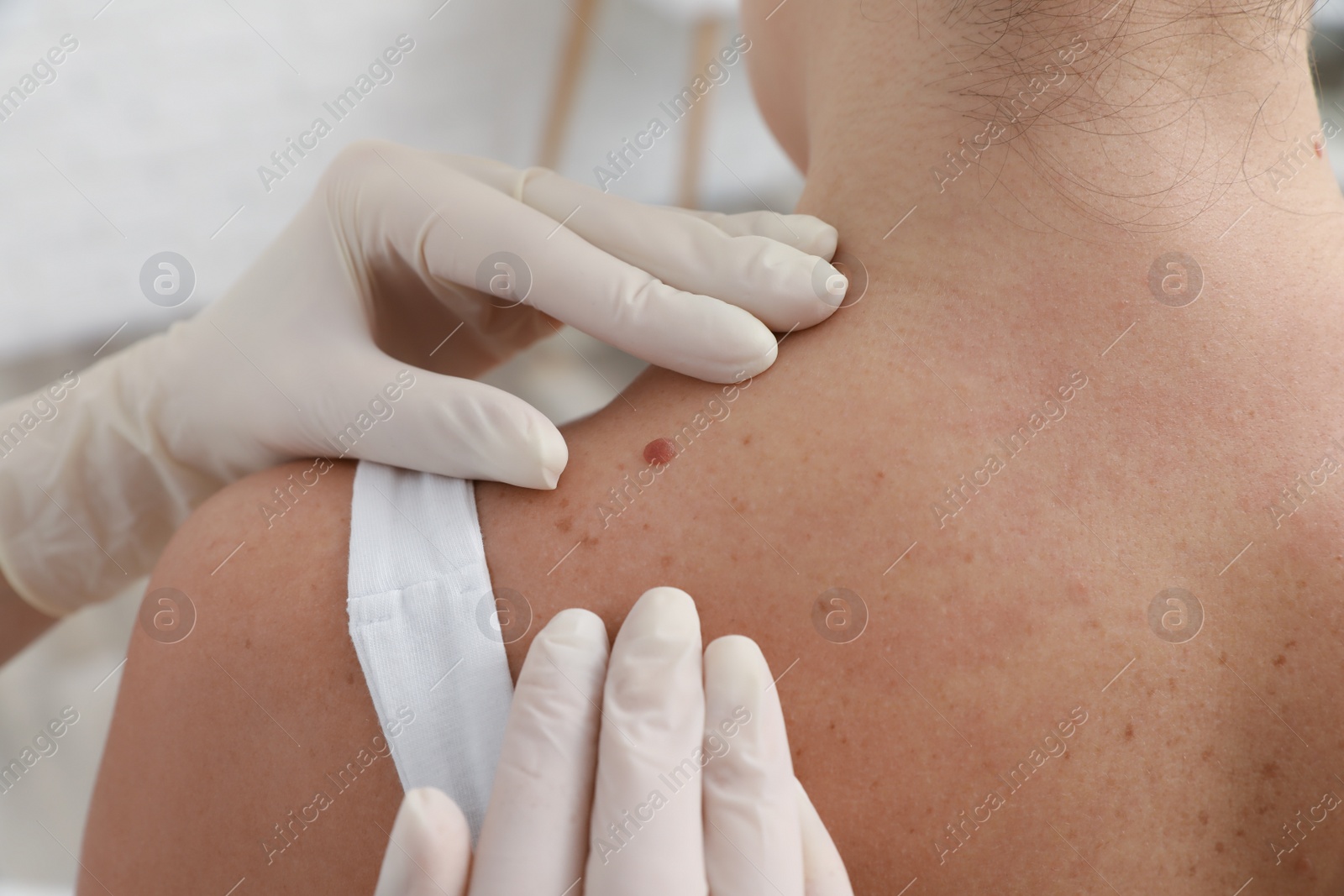 Photo of Dermatologist examining patient's birthmark in clinic, closeup