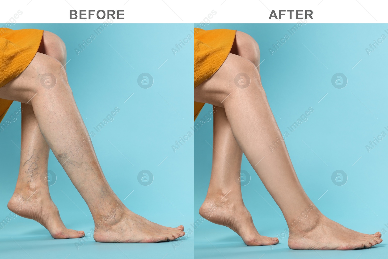 Image of Before and after varicose veins treatment. Collage with photos of woman showing legs on light blue background, closeup