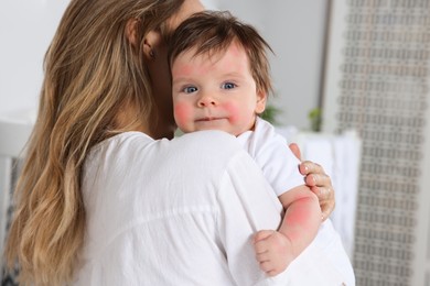 Image of Mother hugging her cute daughter at home. Little baby with allergic redness