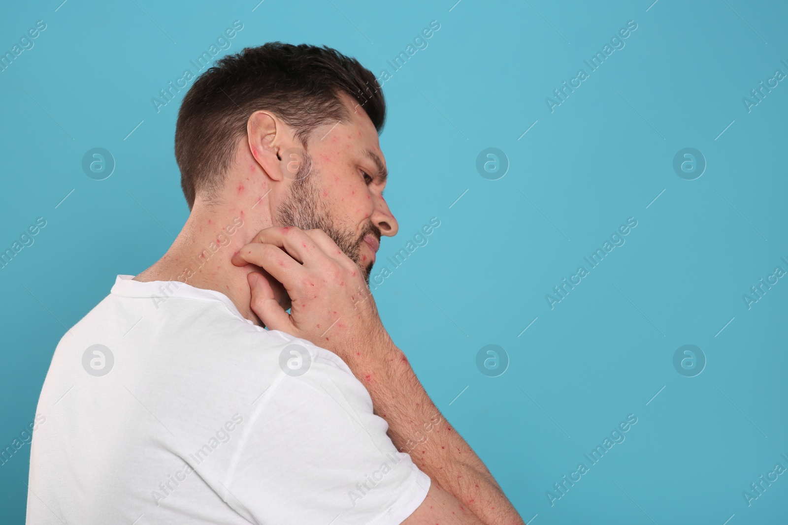 Photo of Man with rash suffering from monkeypox virus on light blue background. Space for text